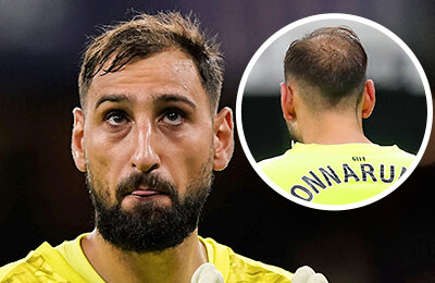 Доннарумма в 26 стремительно теряет шевелюру. Почему так рано?