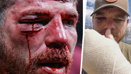 23 шва под глазом и сломанные рука и палец на ноге – выживший на UFC 300