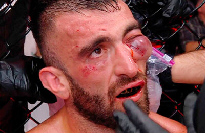 6 нокдаунов за 2 раунда и страшная гематома – жесть на UFC в Абу-Даби