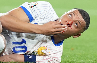 Фото дня: Мбаппе в крови и со сломанным носом. Сыграет ли еще на Евро?