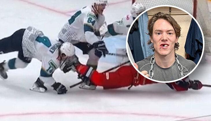 Страшное в КХЛ: игрок получил лезвием конька по лицу и потерял зубы