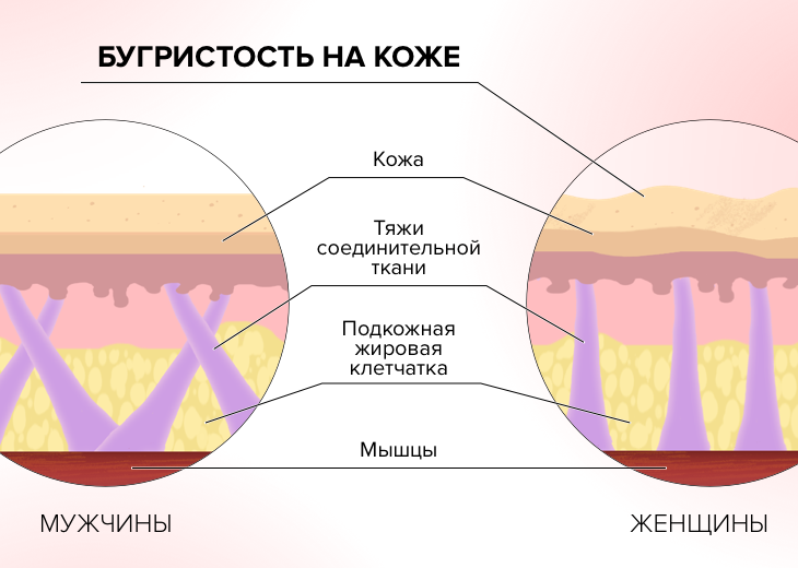 Бугристая местность: эксперт комментирует все стадии звездного целлюлита