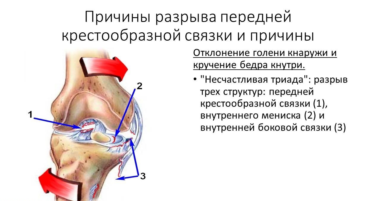 Повреждение кса коленного сустава. Разрыв связок ПКС коленного сустава. Операция пластика связки коленного сустава. Повреждение связок и мениска коленного сустава. Задняя крестообразная связка коленного сустава анатомия.