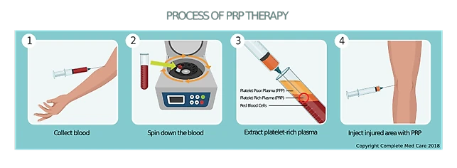 Prp терапия при грыже. Prp-терапия (platelet rich plasma).