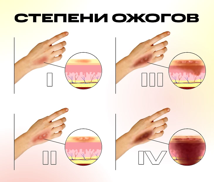 Первая помощь при ожогах