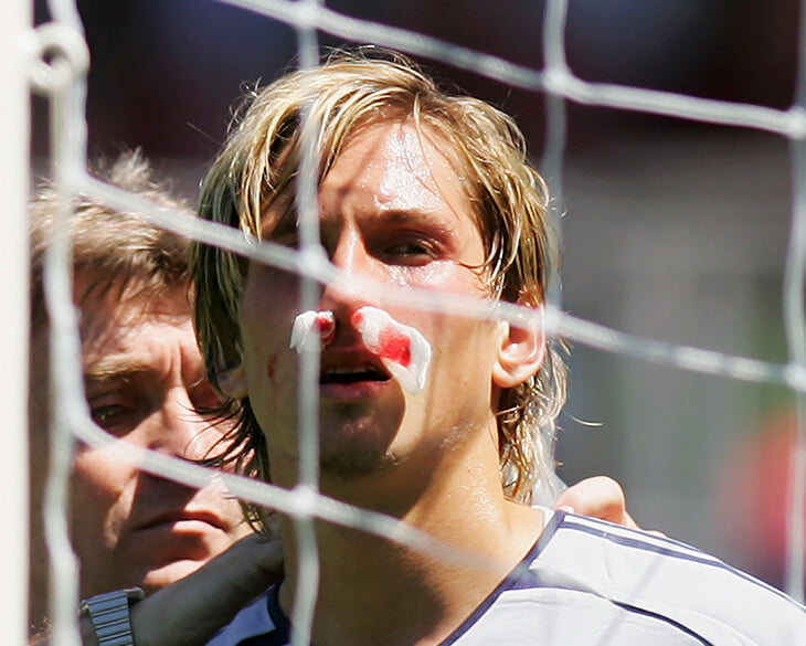 Оказывается, у Адлера кривой нос из-за Месси. Перелом от удара мячом!