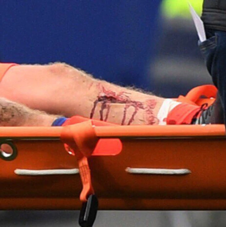 Травма Понтуса Вернблума!