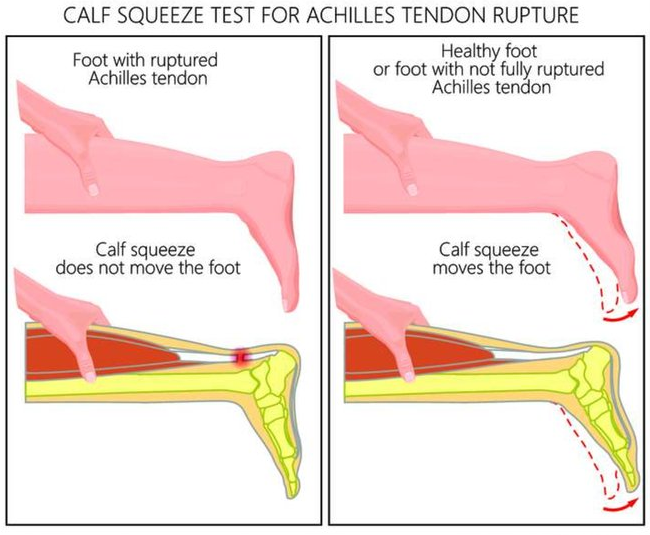 Разрывы ахиллова сухожилия