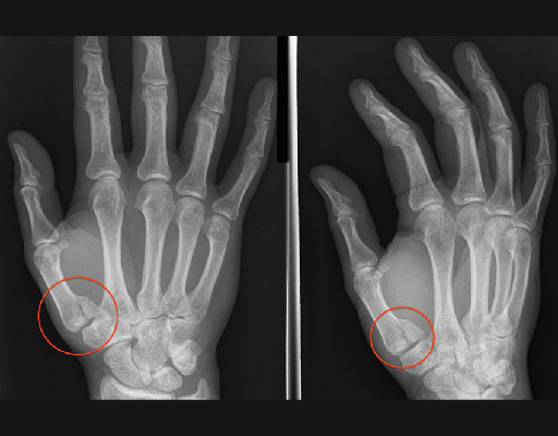 Симптомы вывиха пальца на руке