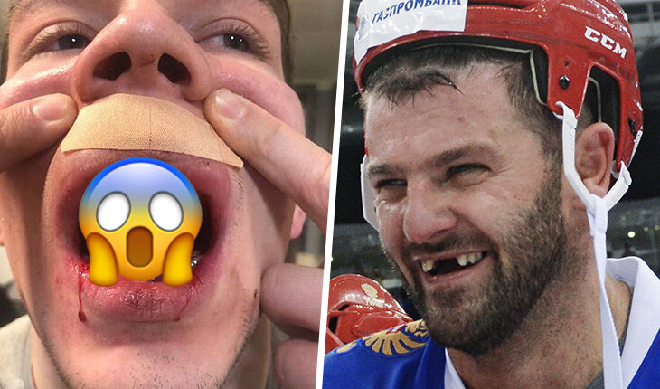 😱 Радулов вынес всю верхнюю челюсть сопернику силовым приемом. Реально – остался один (!) зуб