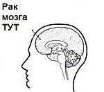 Рак твоего мозга, Рак твоего мозга