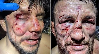 Лица Двалишвили и Сехудо после UFC 323 – жесть! Им устроили избиение 😮